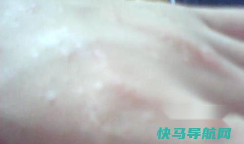 脚气怎么根治最佳 第2张