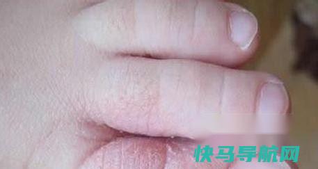 脚气怎么根治最佳 第3张