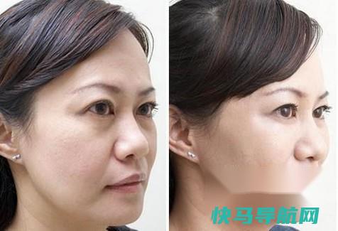全脸脂肪填充几天消肿 第2张